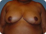 Breast_Reduction_Thumb_opt